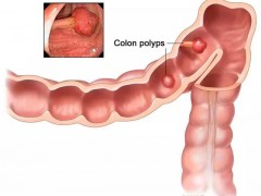 四十岁以上的人注意！了解结直肠癌的8个蛛丝马迹可躲过一劫！