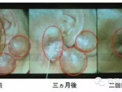 喜讯！日本新一代抗癌技术——硼中子俘获疗法即将招募患者！