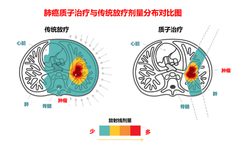 3-18-6-质子治疗肺癌对比图