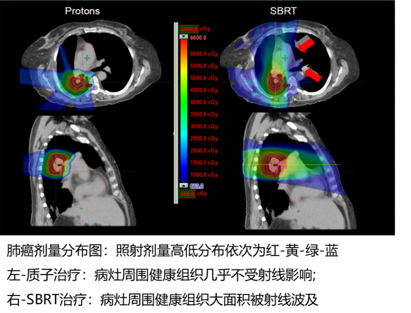 4-8-2肺癌质子治疗图谱