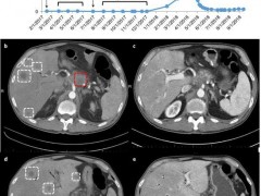 Nature：突破屏障！新联合疗法为胰腺癌患者带来希望！