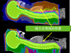 10岁患髓母细胞瘤，如今23岁无瘤，健康，正常生活！多亏质子治疗