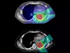 首次对比！癌症的质子治疗比传统放疗的副作用降低三分之二！