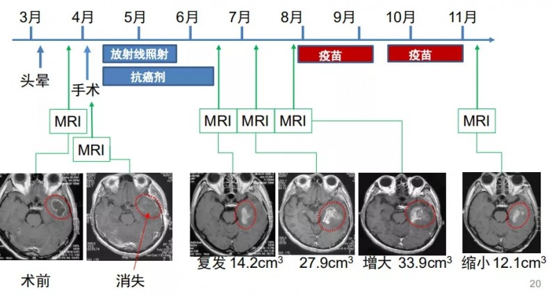 胶质细胞瘤融合细胞免疫治疗效果