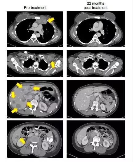 乳腺癌til疗法治疗后影像对比