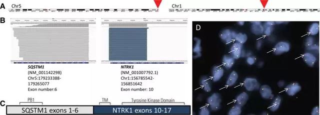 SQSTM1-NTRK1突变