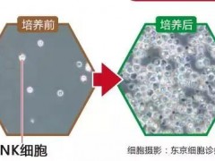 免疫力降低会得癌？别傻了，这些指标异常才是癌症征兆