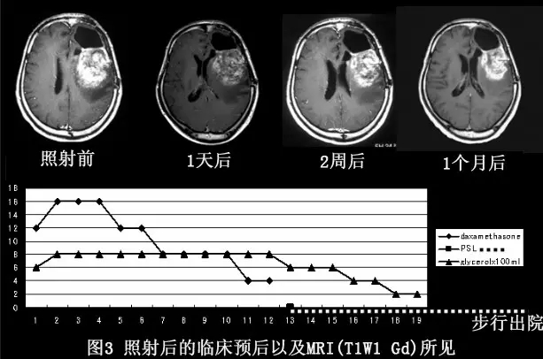 脑瘤硼中子治疗前后对比