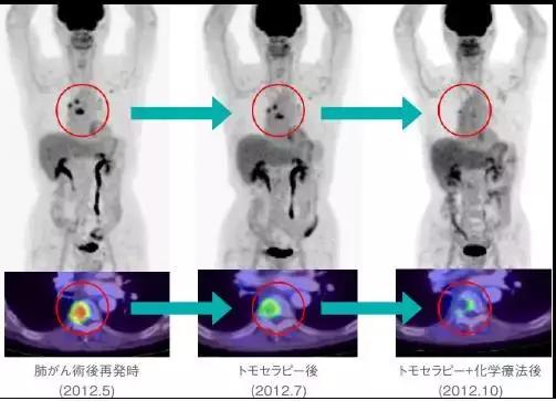拓姆刀治疗效果