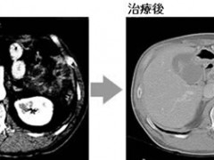 癌王也有软肋，胰腺癌这样治疗后肿瘤病灶消失2/3