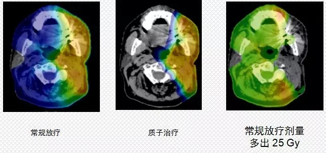 质子治疗和常规放疗照射剂量对比