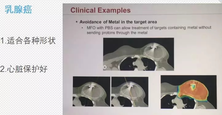 乳腺癌质子治疗