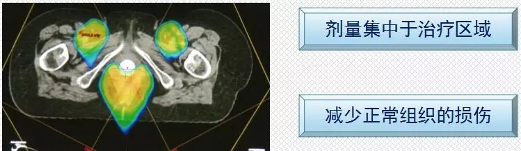 卵巢癌、胰腺癌质子治疗