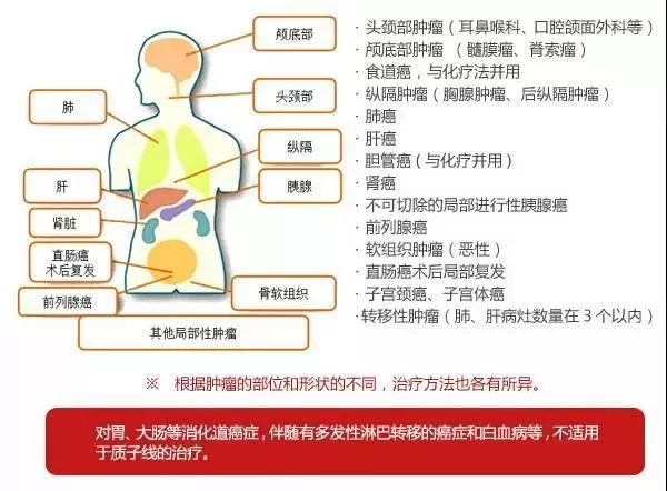 质子治疗适应症
