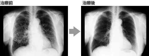 Imfinzi治疗肺癌，肿瘤消失了