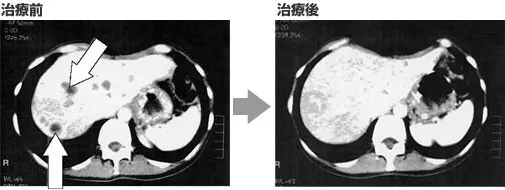 胃癌NK细胞治疗联合化疗治疗前后对比