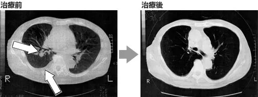 结直肠癌NK细胞免疫治疗前后对比