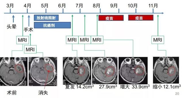 脑胶质细胞瘤融合细胞疗法治疗前后对比