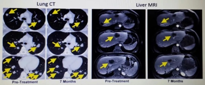 左：肺部CT；右肝MRI