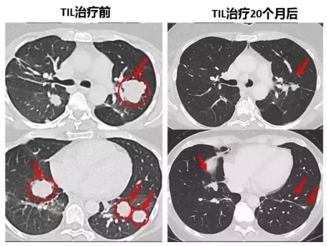 肺癌TIL疗法治疗前后对比