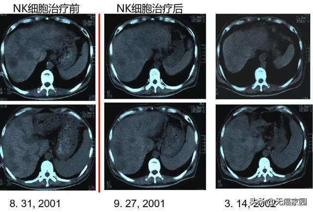 结肠癌肝转移nk细胞治疗前后