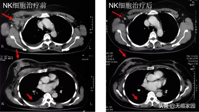 晚期乳腺癌nk治疗前后