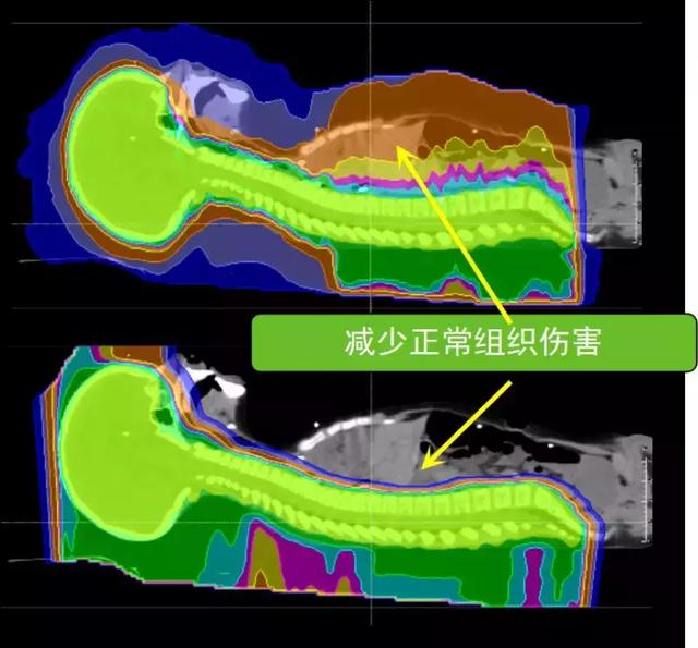 儿童颅咽管癌质子治疗