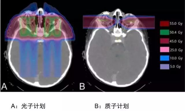 髓母细胞瘤质子治疗