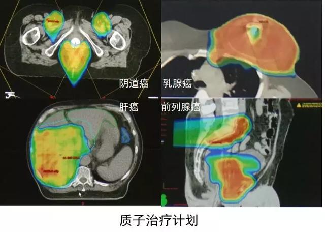 质子治疗