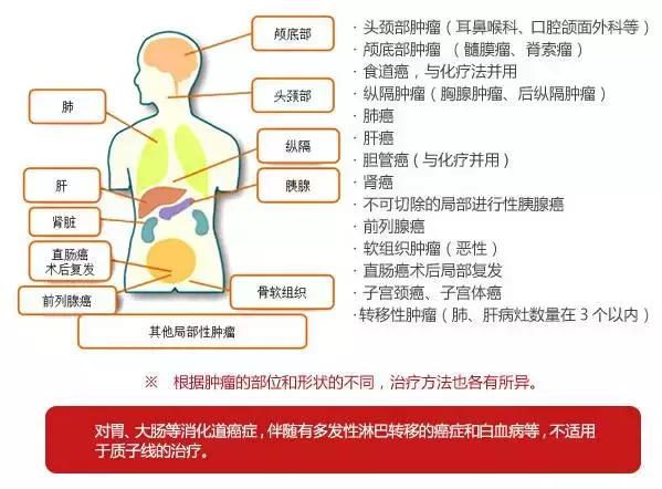 质子治疗适应症人体分布图