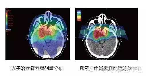 脊索瘤质子治疗和普通放疗对比