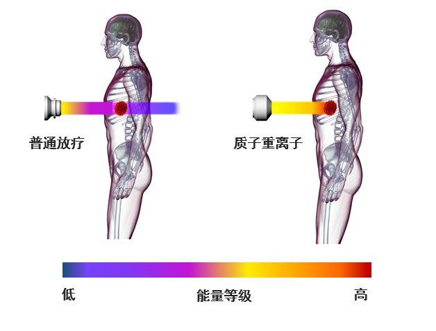 普通放疗和质子治疗对比