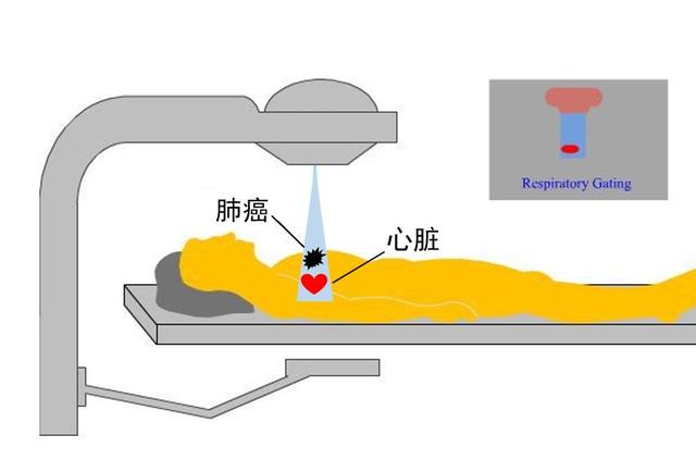 质子重离子治疗的优势