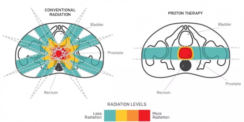 Is proton therapy better than radiation for prostate cancer