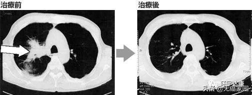 nk细胞治疗前后对比