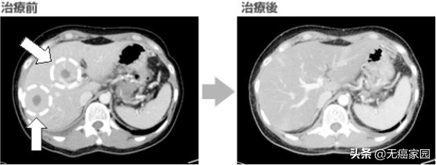 nk细胞治疗前后对比