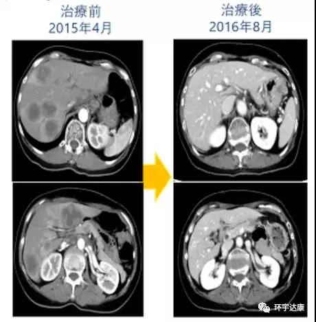 树突疫苗治疗前后对比