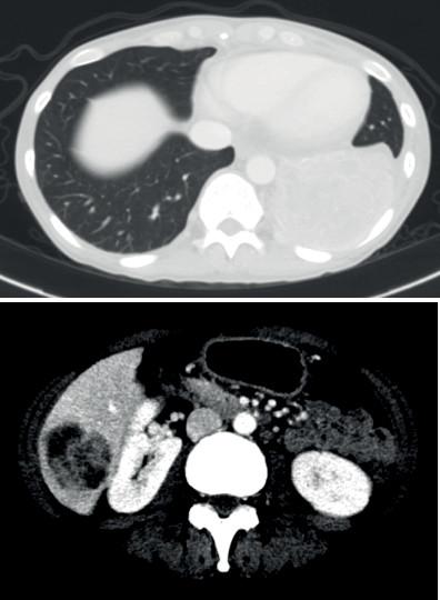 IV期非小细胞肺腺癌治疗前