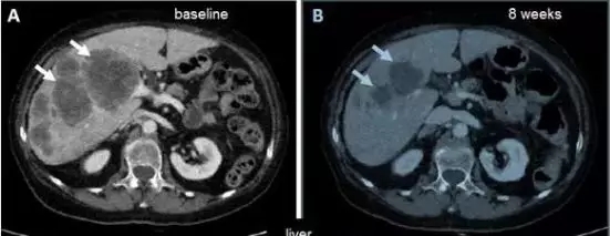 肝转移瘤明显萎缩