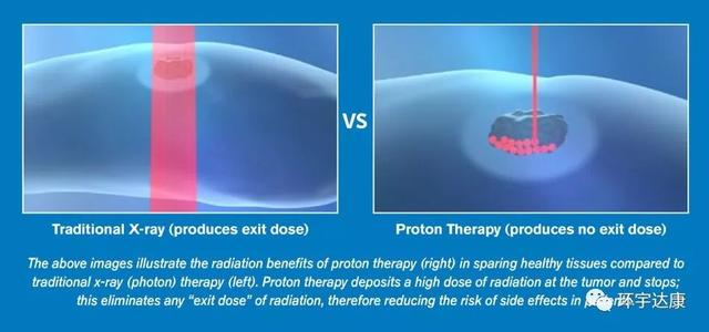 质子治疗的优势