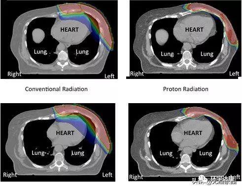 乳腺癌质子放疗和传统放疗CT图对比
