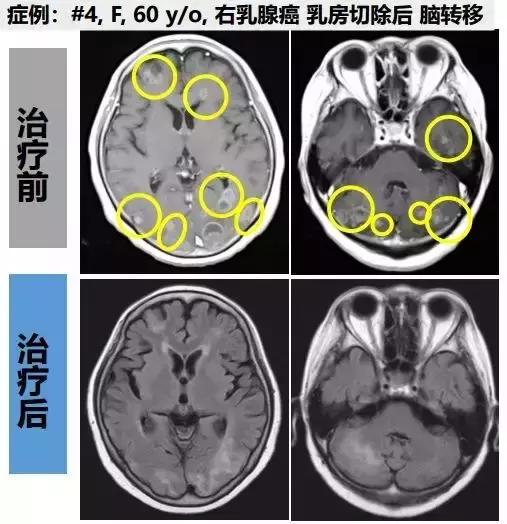 乳腺癌细胞免疫治疗前后影像