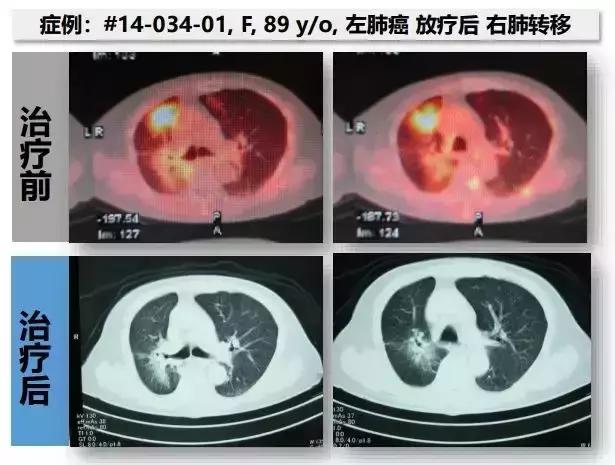 肺癌细胞免疫治疗前后影像对比