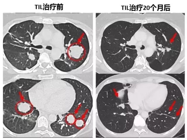 肺部肿瘤TILS治疗前后对比