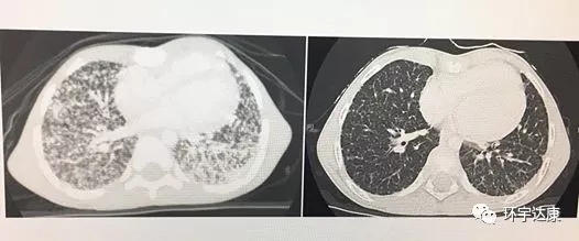 晚期甲状腺癌影像图