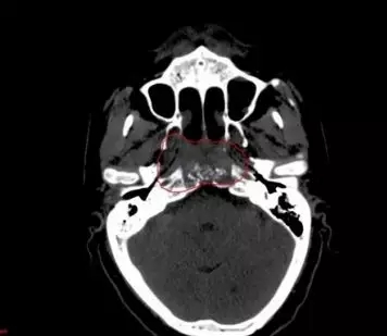 鼻咽癌治疗前CT图像