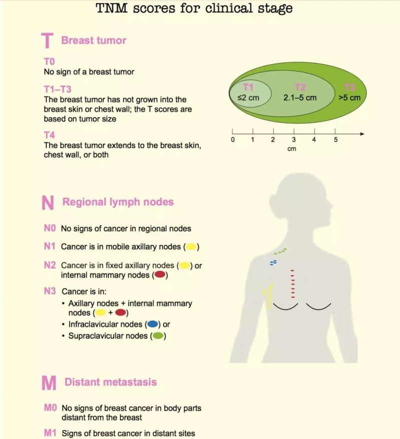 乳腺癌分期