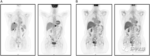 胰腺癌肝转移PET-CT扫描：（A）治疗前（B）拉罗替尼治疗后