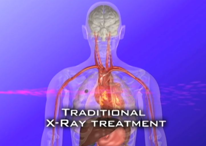 传统放疗射线会穿透肿瘤，将剂量落在健康组织上