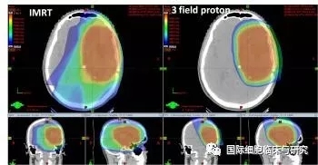 脑瘤质子治疗